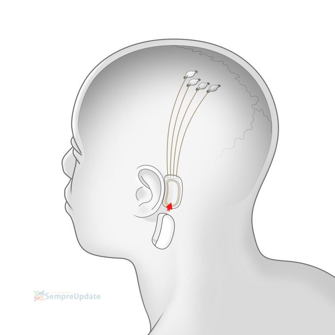 Elon Musk disse que uma atualização da tecnologia cérebro-computador do Neuralink está chegando