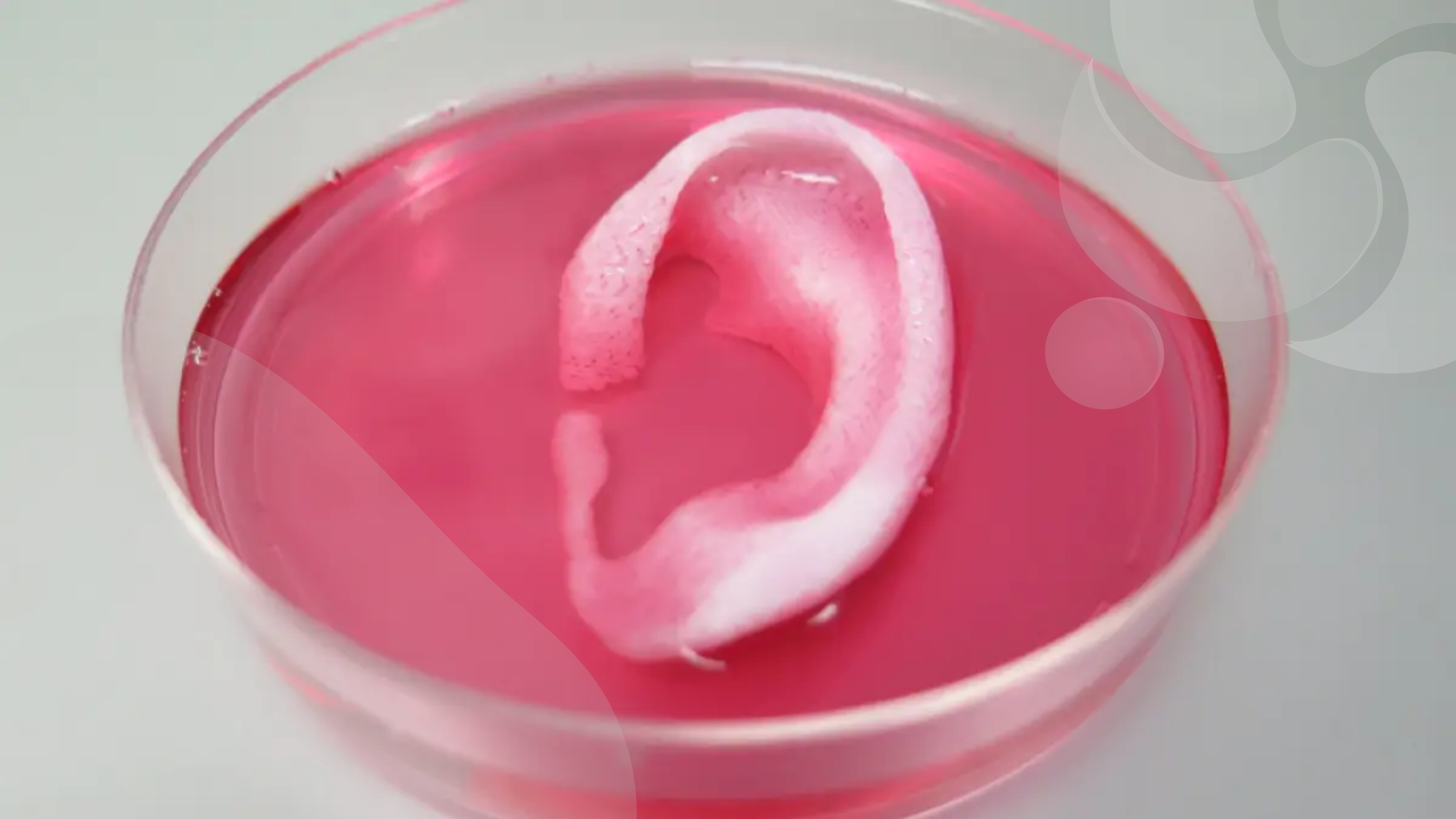 transplante-de-orelha-bioimpressa-em-3d-e-realizado-para-tratar-a-microtia-de-um-paciente